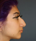 Feel Beautiful - Rhinoplasty 218 - Before Photo